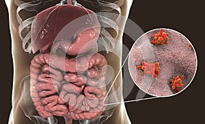 Entamoeba histolytica protozoan infection of large intestine