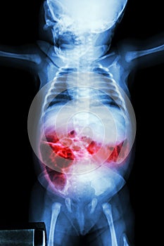 Enteritis (X-ray of sick infant and inflammation of intestine)