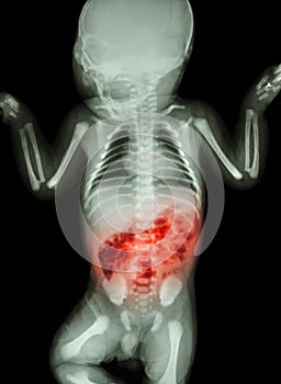 Enteritis (X-ray of sick infant and inflammation of intestine)