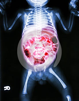 Enteritis (X-ray of sick infant and inflammation of intestine)