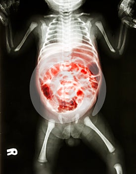 Enteritis (X-ray of sick infant and inflammation of intestine)