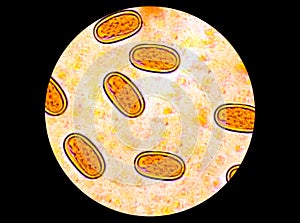 Enterobius vermicularis (EV) eggs. parasite in stool, image under light microscopy.