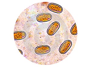 Enterobius vermicularis (EV) eggs. parasite in stool, image under light microscopy.