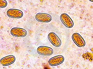 Enterobius vermicularis (EV) eggs. parasite in stool, image under light microscopy.
