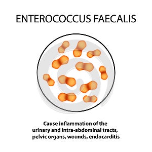 Enterococcus faecalis. Pathogenic flora. The bacterium causes intestinal diseases. Infographics. Vector illustration. photo