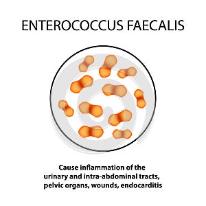Enterococcus faecalis. Pathogenic flora. The bacterium causes intestinal diseases. Infographics. Vector illustration. photo