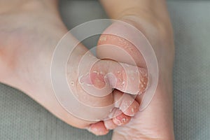 Enterovirus foot hand mouth Skin peeled off on the body of a child Cocksackie virus photo