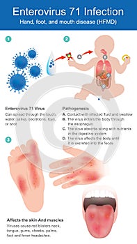Enterovirus 71 Infection.Hand, foot, and mouth disease.