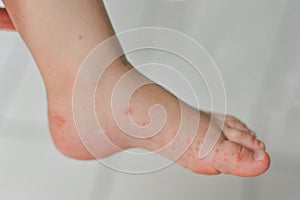 Enterovirus Leg arm mouth Rash on the body of a child Cocksackie virus photo