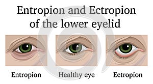 Entropion and Ectropion of the lower eyelid photo