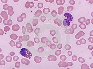 Eosinophil and neutrophil seen on peripheral blood smear