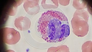 Eosinophil and red blood cells on peripheral blood smear