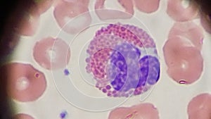 Eosinophil and red blood cells on peripheral blood smear photo