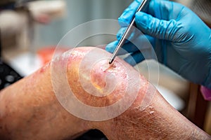Epidermolysis bullosa, doctor removes scab and slough from the knee photo