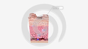 Epidermolytic ichthyosis (EI) is a genetic skin disorder