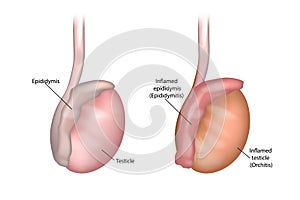 Epididymitis Inflamed epididymis And Orchitis