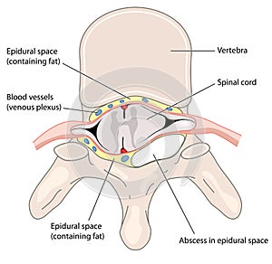 Epidural abscess