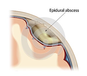 Epidural abscess vector