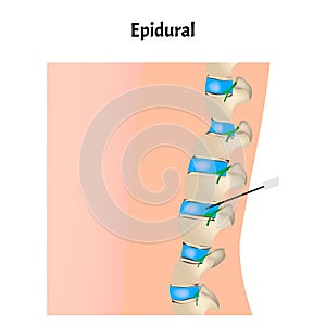 Epidural anesthesia during childbirth. Epidural anesthesia of pregnant women. Vector illustration.