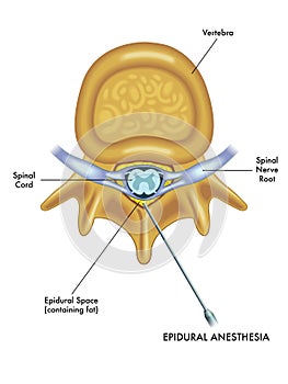 Epidural anesthesia diagram