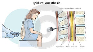 epidural anesthesia structure diagram medical