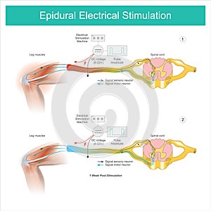 Epidural Electrical Stimulation. Muscle pain symptom in the leg area and treatment by electrical stimulation on skin and then photo