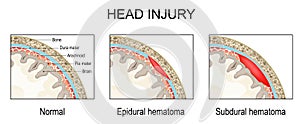 Epidural hematoma and Subdural hematoma. Traumatic brain injury photo