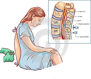 Epidural Nerve Block Injection illustration photo