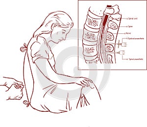 Epidural Nerve Block Injection illustration