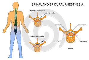 Epidural and spinal anaesthesia photo