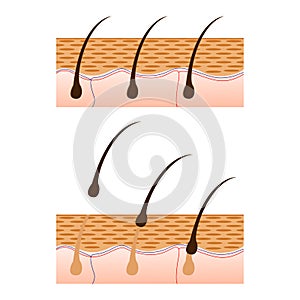 Epilation and skin with hair sectional view.