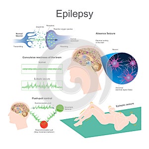 Epilepsy