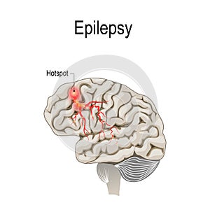 Human brain with hotspot hotspot of epilepsy