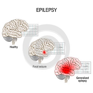 Epilepsy. EEG of healthy brain and epileptic seizure. photo