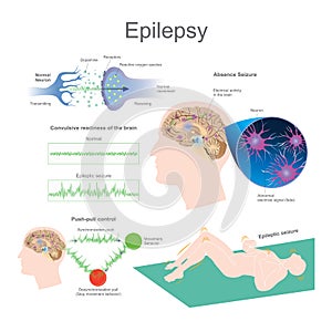 Epilepsy photo