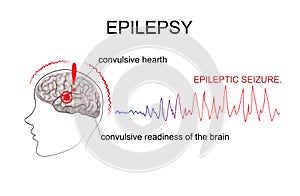 EPILEPSY, factors of emergence photo