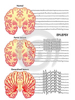 Epilepsy photo