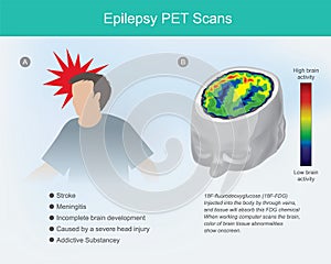 Epilepsy PET scans. photo