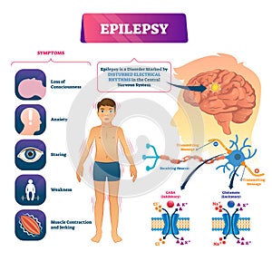 Epilepsy vector illustration. Labeled sick CNS disorder educational scheme.