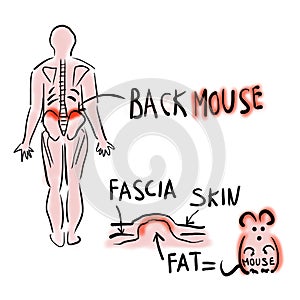 Episacral lipoma or back mouse photo