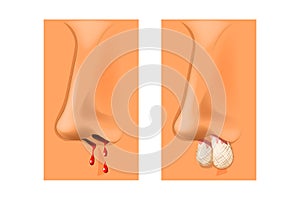 Epistaxis, nasal packing.