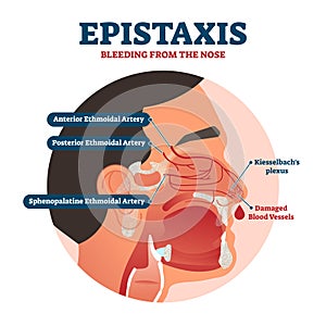 Epistaxis vector illustration. Bleeding from nose explanation health scheme