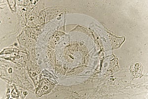 Epithelial cells with bacteria in patient urine