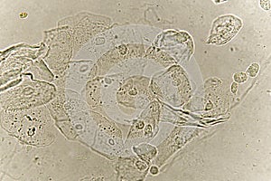 Epithelial cells with bacteria in patient urine