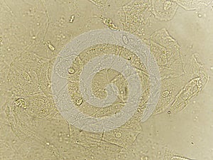 Epithelial cells with bacteria in patient urine