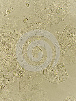 Epithelial cells with bacteria in patient urine