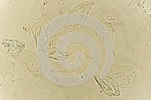 Epithelial cells with bacteria in patient urine