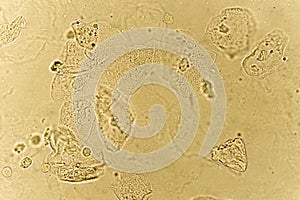 Epithelial cells with bacteria in patient urine photo