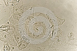 Epithelial cells with bacteria in patient urine photo