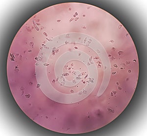 Epithelial cells with bacteria in patient urine (urinary tract infections). photo